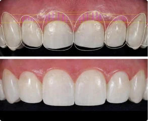 More Esthetic Crown Lengthening and Veneer Procedures