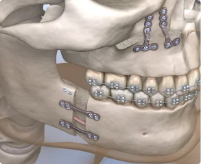 More Fee-for-Service Orthognathic Surgeries