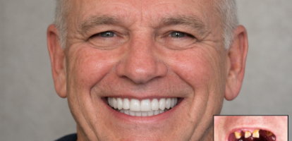 Why High-Cost Full Mouth Rehab Cases Stall and How to Fix It