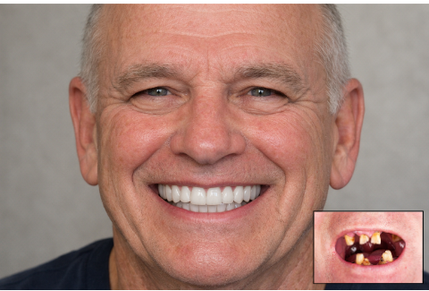 Why High-Cost Full Mouth Reconstruction Cases Stall and How to Fix It
