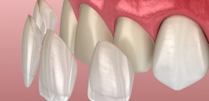 Presenting a $30,000 Smile Makeover Without Losing the Patient on Price