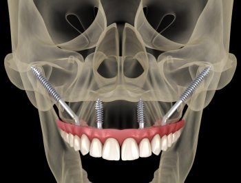 More All-on-X and Zygomatic Dental Implant Cases