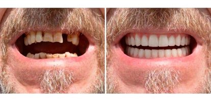 The Story of Robert and Use of Home Equity for Dental Care